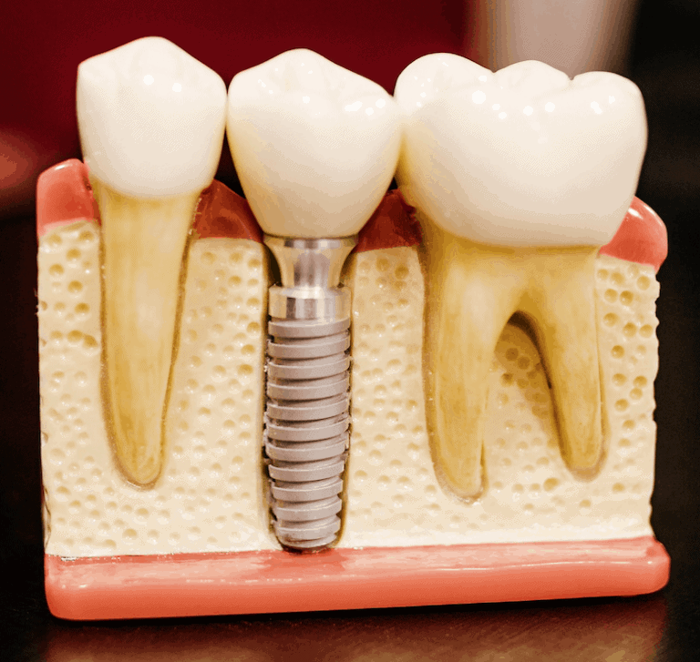 Niet essentieel reservoir Rubber Implantaten, zo werkt dat | Amstel Dental